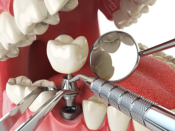 Best Emergency Tooth Extraction in Coal Valley, IL